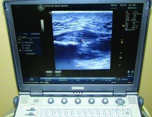 Physicians use ultrasound guidance to pinpoint the injured area for treatment