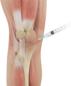 cortisone injections